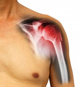 Roentgenblick Schulter 1a2